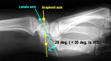 lunotriquetral ligament injury hand test